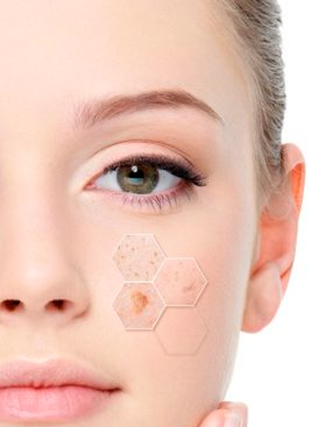 Skin Blemishes International Day