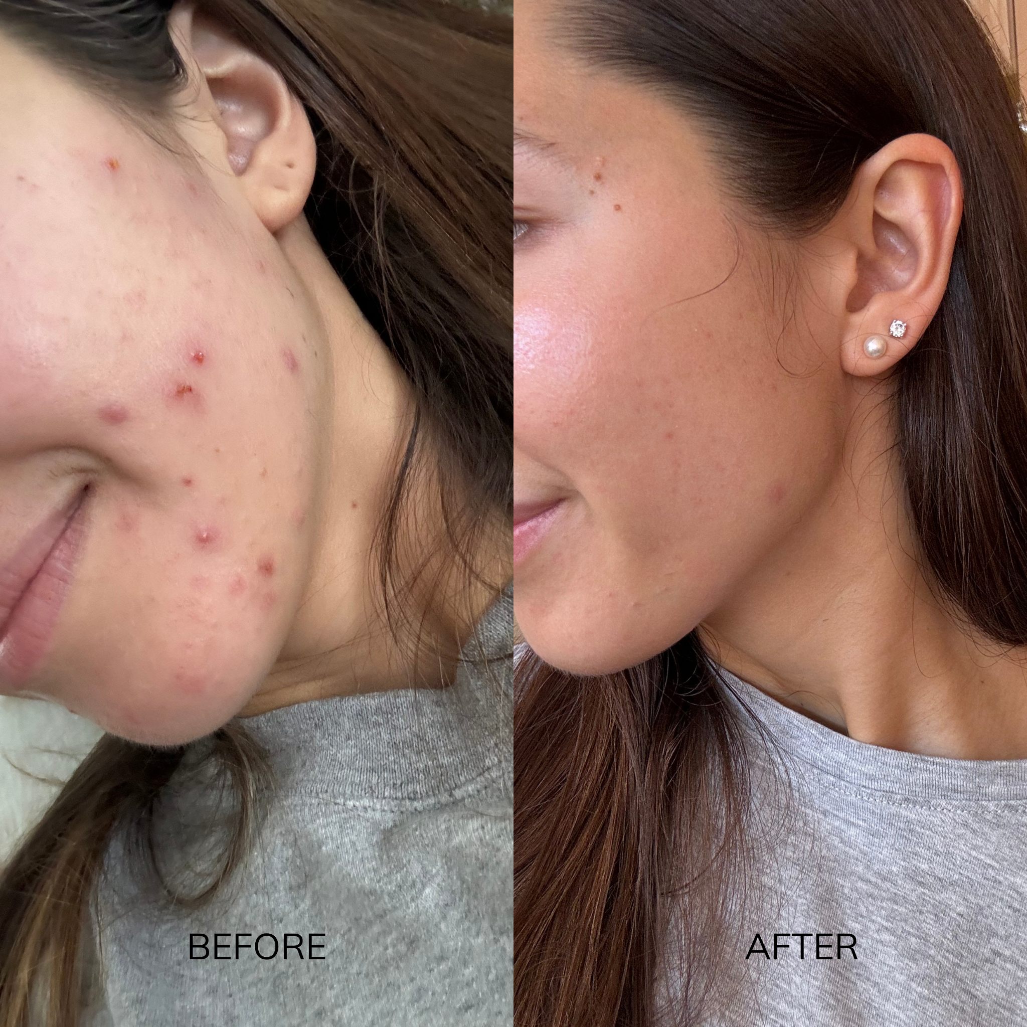 Oily & Acne Prone Routine